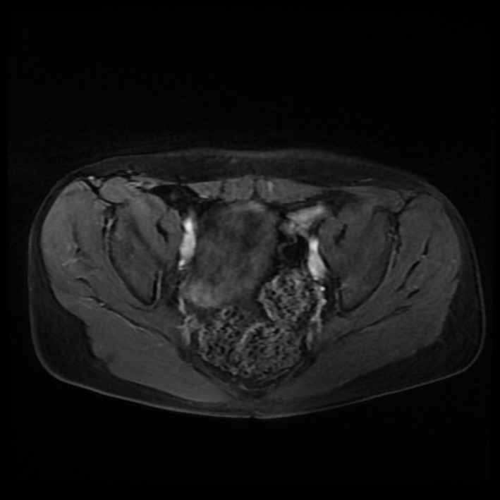 Ambiguous genitalia (Radiopaedia 69686-79643 Axial T1 C+ fat sat 22).jpg