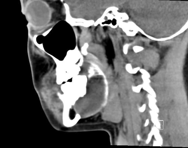 File:Ameloblastoma (Radiopaedia 26645-26793 Sagittal C+ delayed 12).jpg