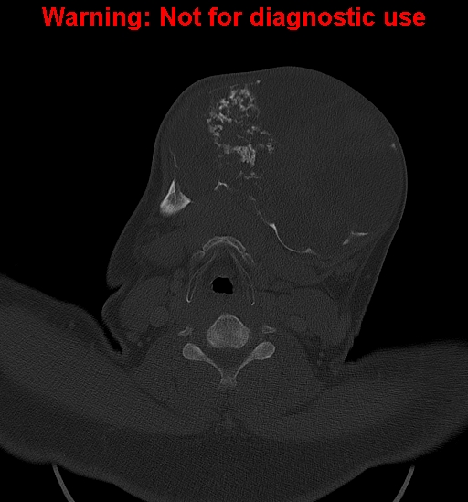 File:Ameloblastoma (Radiopaedia 33126-34164 Axial bone window 23).jpg