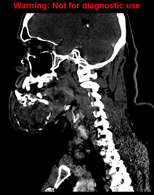 Ameloblastoma (Radiopaedia 33126-34164 F 43).jpg