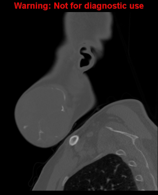 Ameloblastoma (Radiopaedia 33126-34164 Sagittal bone window 14).jpg