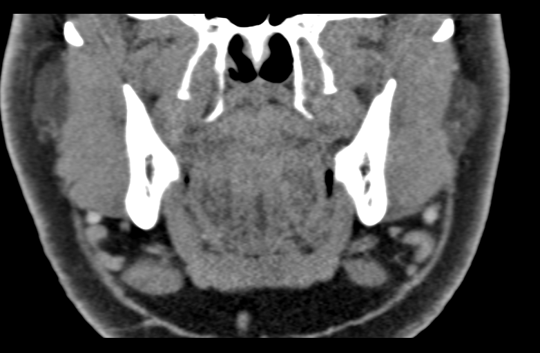 Ameloblastoma (Radiopaedia 33677-34806 Coronal non-contrast 31).png