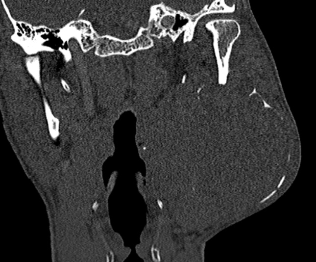 Ameloblastoma (Radiopaedia 51921-57766 Coronal bone window 185).jpg