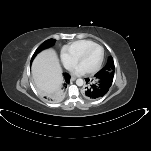 File:Amoebic liver abscess (Radiopaedia 52611-58530 A 9).png