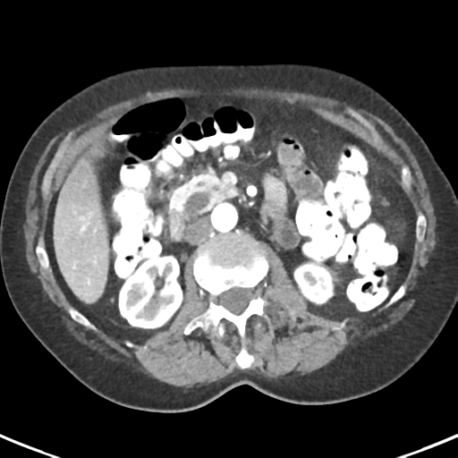 Ampullary adenocarcinoma (Radiopaedia 34013-35237 B 40).png