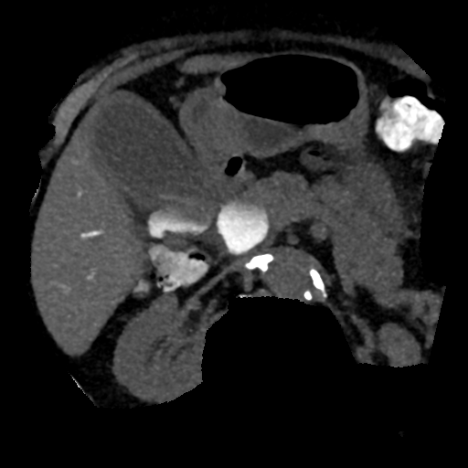 Ampullary adenocarcinoma (Radiopaedia 34013-35241 AXIAL MIPS 3-1.5 55).png