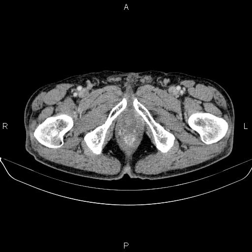 Ampullary adenocarcinoma (Radiopaedia 86093-102032 A 59).jpg