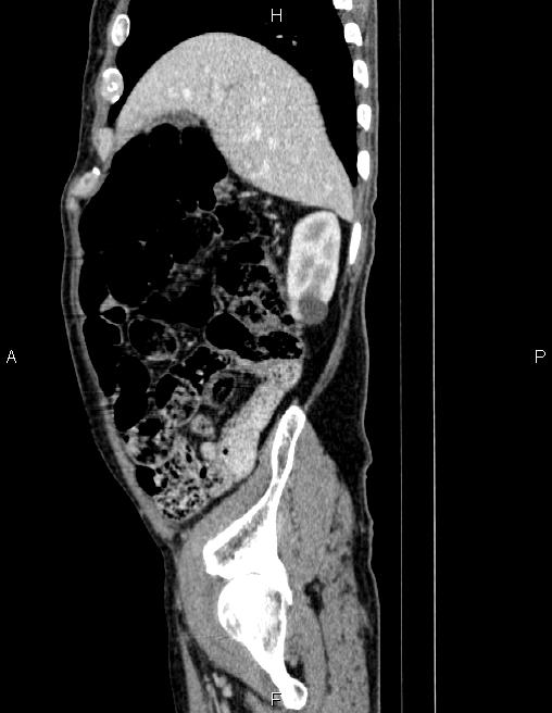 Ampullary adenocarcinoma (Radiopaedia 86093-102032 D 19).jpg