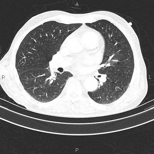 Ampullary adenocarcinoma (Radiopaedia 86093-102033 Axial lung window 34).jpg