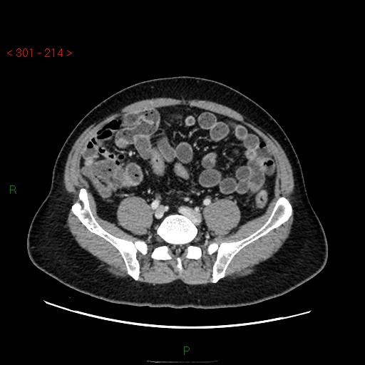 Ampullary carcinoma (Radiopaedia 56396-63056 C 70).jpg