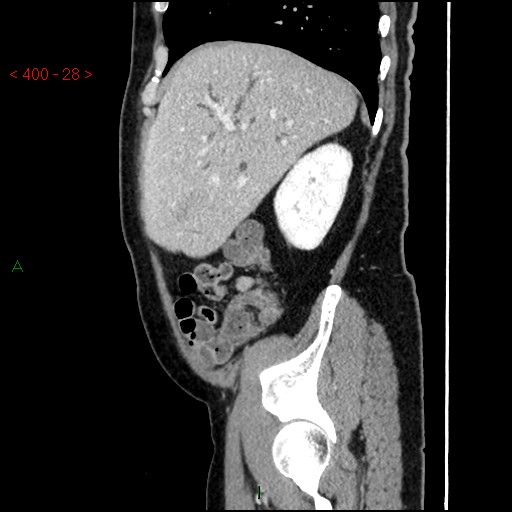 Ampullary carcinoma (Radiopaedia 56396-63056 D 27).jpg