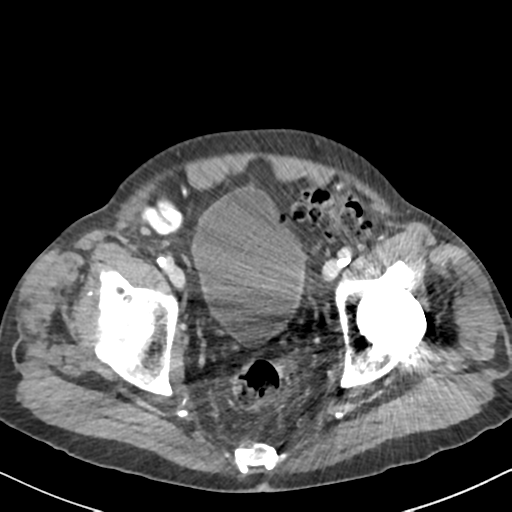 File:Amyand hernia (Radiopaedia 39300-41547 A 64).png