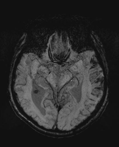 File:Amyloid angiopathy with inflammation (Radiopaedia 30360-31002 Axial SWI MIP 20).jpg
