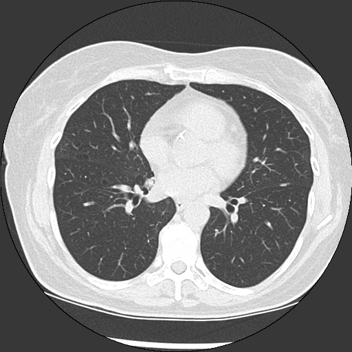 Amyloidosis - bronchial and diffuse nodular pulmonary involvement (Radiopaedia 60156-67744 B 33).jpg