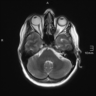 File:Amyotrophic lateral sclerosis (Radiopaedia 70821-81017 Axial T2 8).jpg