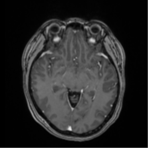 Anaplastic astroblastoma (Radiopaedia 55666-62194 Axial T1 C+ 33).png