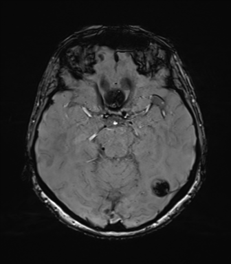 Anaplastic astrocytoma (Radiopaedia 86943-103160 Axial SWI 37).png