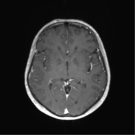 File:Anaplastic astrocytoma (Radiopaedia 86943-103160 Axial T1 C+ 24).png