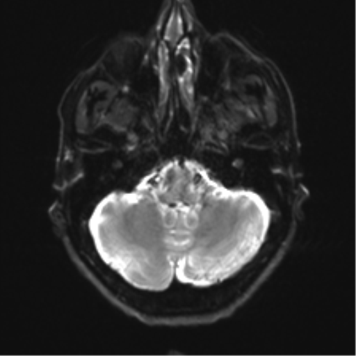 Anaplastic astrocytoma - thalamic glioma (Radiopaedia 59709-67115 Axial DWI 7).png