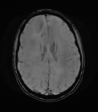 File:Anaplastic astrocytoma IDH mutant (Radiopaedia 50046-55341 Axial SWI 57).png