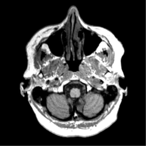 Anaplastic astrocytoma IDH wild-type (pseudoprogression) (Radiopaedia 42209-45277 Axial T1 13).png