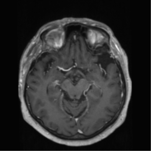 File:Anaplastic astrocytoma IDH wild-type (pseudoprogression) (Radiopaedia 42209-45278 Axial T1 C+ 69).png