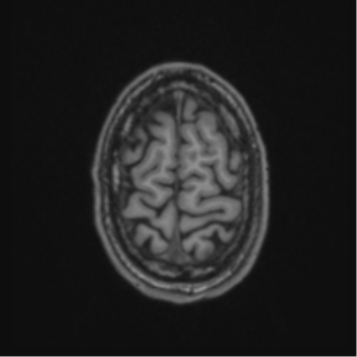 Anaplastic oligodendroglioma with skull fracture (Radiopaedia 74831-85845 Axial T1 59).png