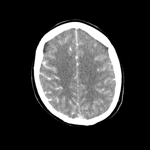 Aneursym related subarachnoid hemorrhage with hydrocephalus (Radiopaedia 45105-49084 D 39).jpg