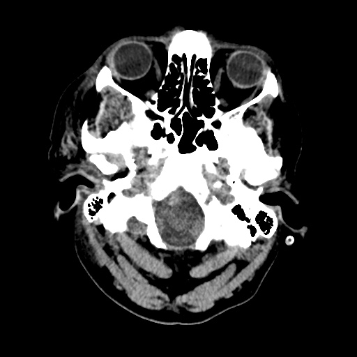 Aneursym related subarachnoid hemorrhage with hydrocephalus (Radiopaedia 45105-49085 Axial non-contrast 4).jpg
