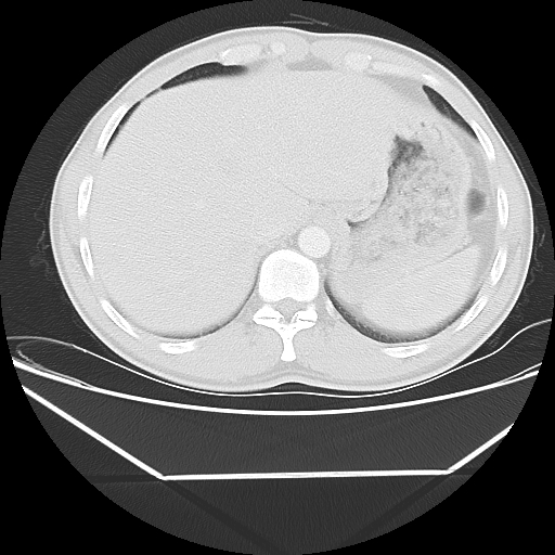 File:Aneurysmal bone cyst - rib (Radiopaedia 82167-96220 Axial lung window 56).jpg