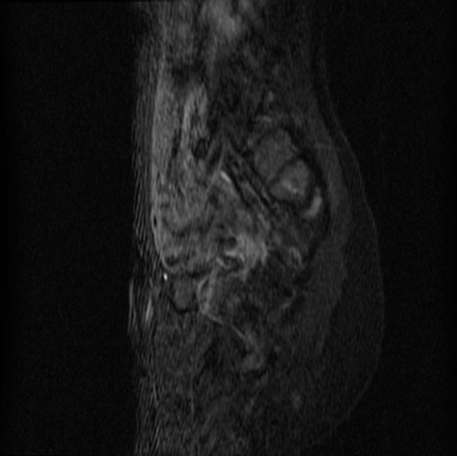 File:Aneurysmal bone cyst - sacrum (Radiopaedia 65190-74196 Sagittal STIR 11).jpg