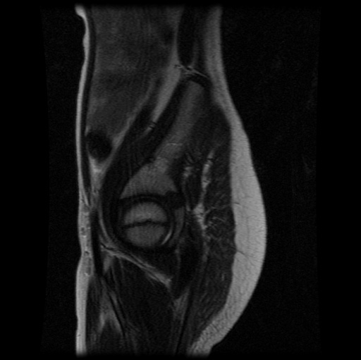 File:Aneurysmal bone cyst - sacrum (Radiopaedia 65190-74196 Sagittal T2 27).jpg