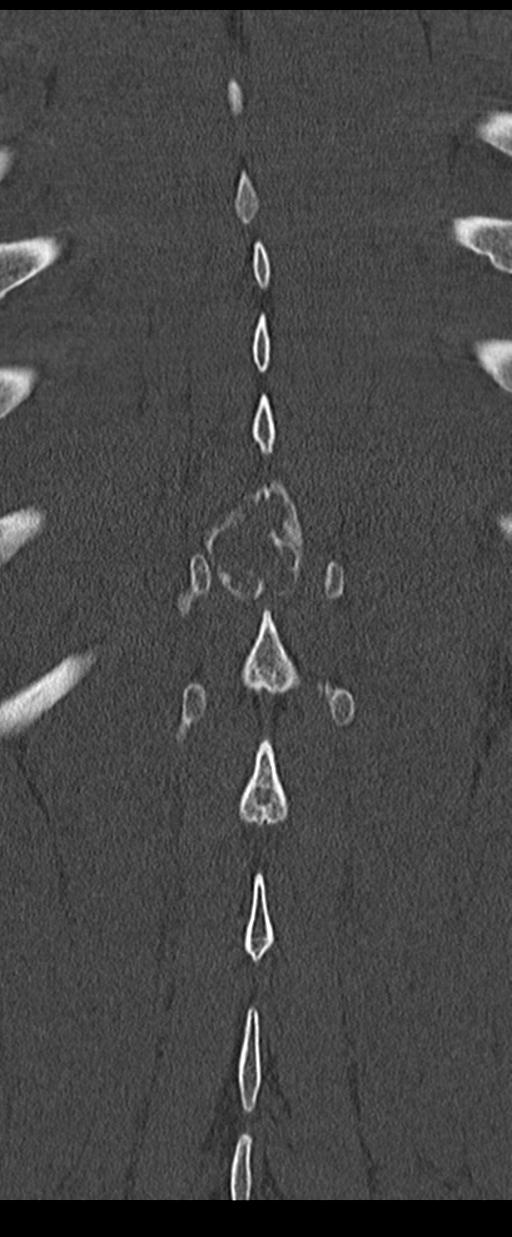 Aneurysmal bone cyst T11 (Radiopaedia 29294-29721 Coronal bone window 54).jpg