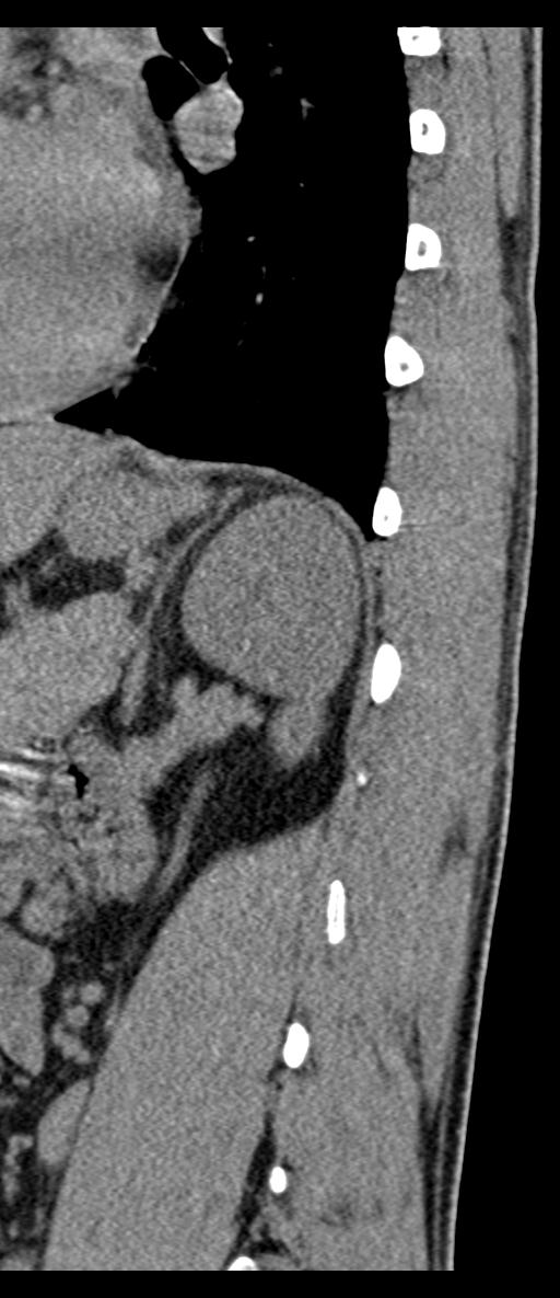 Aneurysmal bone cyst T11 (Radiopaedia 29294-29721 E 13).jpg