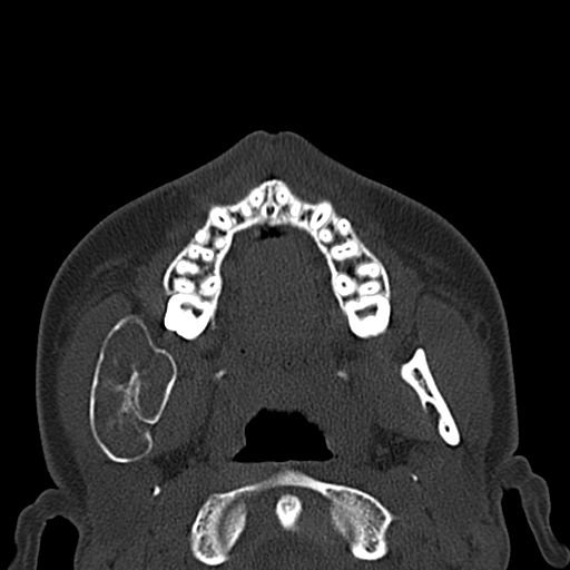 Aneurysmal bone cyst of the mandible (Radiopaedia 43280-46601 Axial bone window 48).jpg