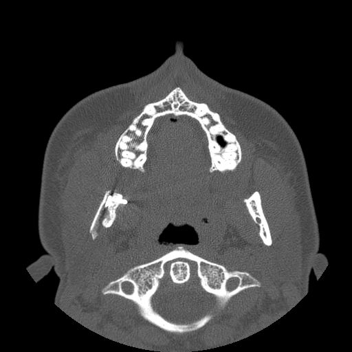 Aneurysmal bone cyst of the mandible (Radiopaedia 43280-46823 Axial bone window 90).jpg