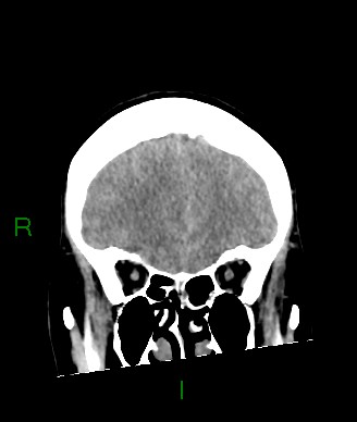 Aneurysmal subarachnoid hemorrhage with intra-axial extension (Radiopaedia 84371-99699 Coronal non-contrast 51).jpg