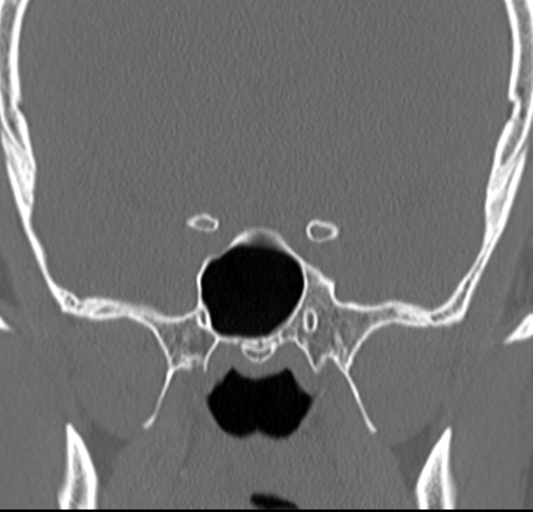Angular epidermoid cyst (Radiopaedia 46908-51439 Coronal bone window 46).png