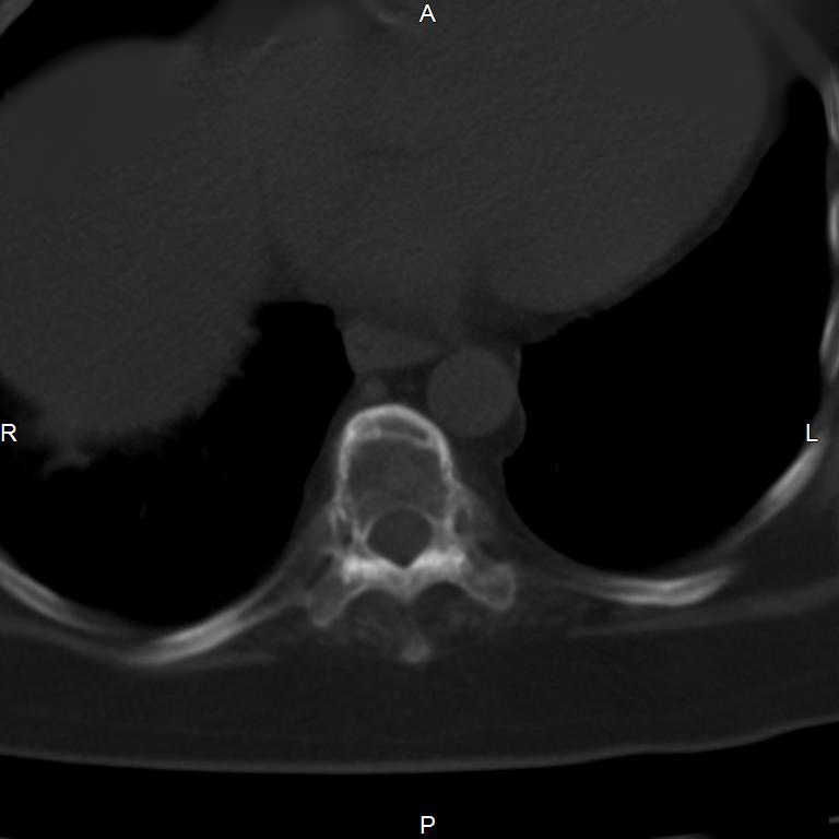 Ankylosing spondylitis (Radiopaedia 8748-9556 Axial bone window 1).jpg