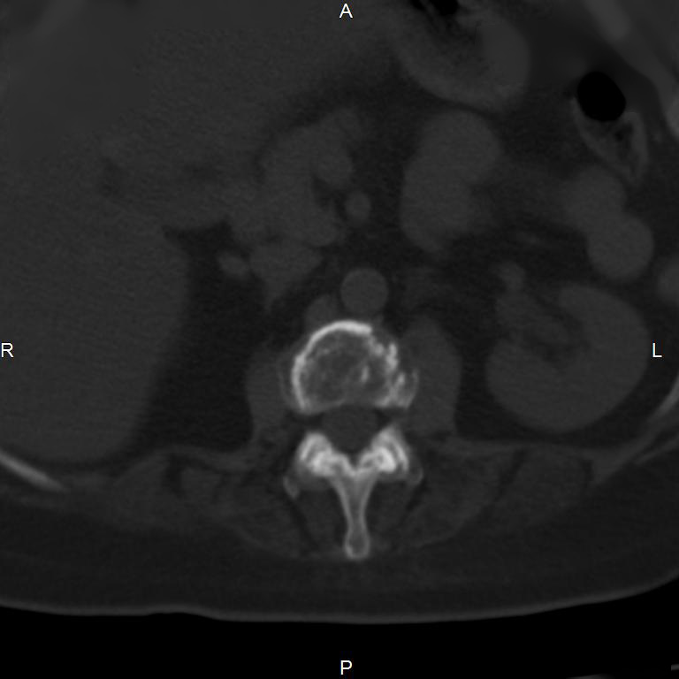 Ankylosing spondylitis (Radiopaedia 8748-9556 Axial bone window 24).jpg
