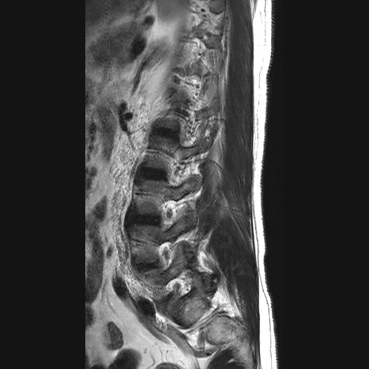 File:Ankylosing spondylitis with zygapophyseal arthritis (Radiopaedia 38433-40516 Sagittal T2 1).jpg