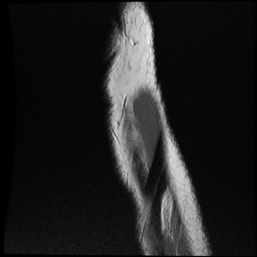File:Anomalous insertion of the medial meniscus (Radiopaedia 77559-89721 Sagittal PD 6).jpg