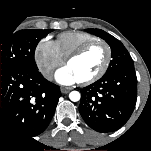 File:Anomalous left coronary artery from the pulmonary artery (ALCAPA) (Radiopaedia 70148-80181 A 223).jpg