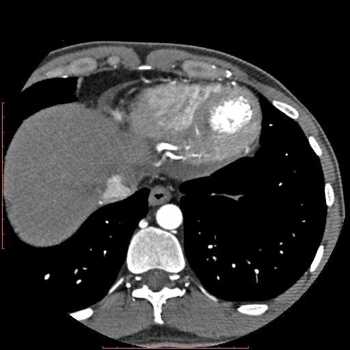 Anomalous left coronary artery from the pulmonary artery (ALCAPA) (Radiopaedia 70148-80181 A 341).jpg