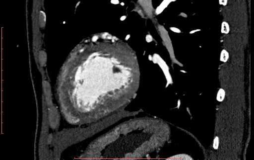 File:Anomalous left coronary artery from the pulmonary artery (ALCAPA) (Radiopaedia 70148-80181 C 195).jpg
