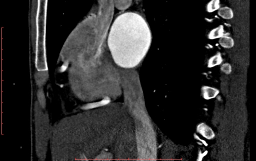 File:Anomalous left coronary artery from the pulmonary artery (ALCAPA) (Radiopaedia 70148-80181 C 57).jpg