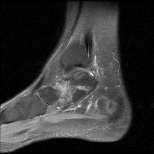 File:Anterior calcaneal process fracture (Radiopaedia 71377-81705 Sagittal PD fat sat 13).jpg
