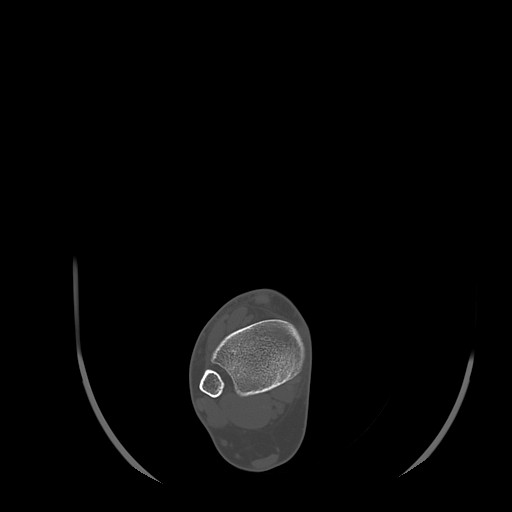 Anterior calcaneal process fracture (Radiopaedia 82590-96762 Axial bone window 6).jpg