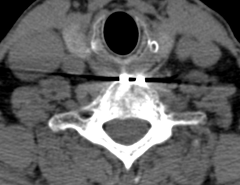 Anterior cervical postdiscectomy arthrodesis (Radiopaedia 32678-33646 Axial non-contrast 57).jpg