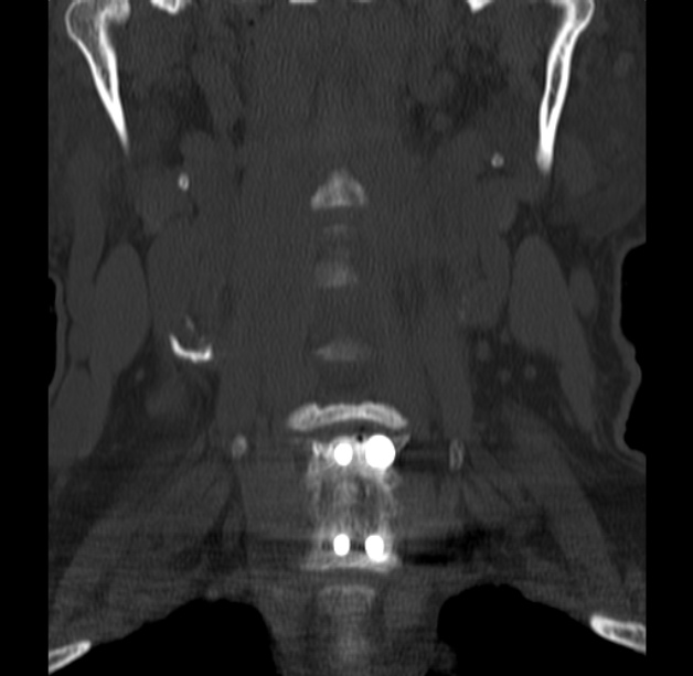 Anterior cervical postdiscectomy arthrodesis (Radiopaedia 32678-33646 Coronal bone window 13).jpg
